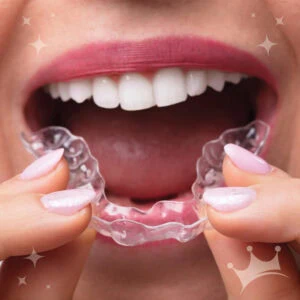 Person holding clear aligners while preparing to place them in their mouth, showcasing modern orthodontic treatment for teeth alignment.