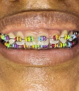 Colorful braces with multiple elastic bands in vibrant shades, showcasing a playful and trendy style, reflecting personal expression and seasonal themes.